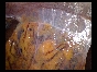 ADHESIONS BOWELS OMENTAL7 ADHESIONS BOWELS OMENTAL7